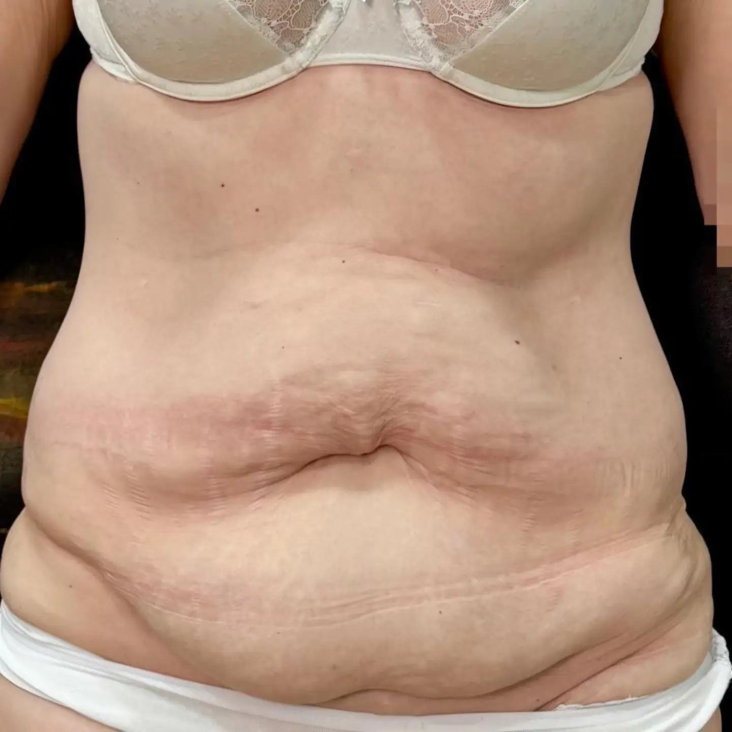 Abdominoplasty Before
